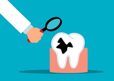 6 حقائق يجب أن تعرفها عن تسوس الأسنان